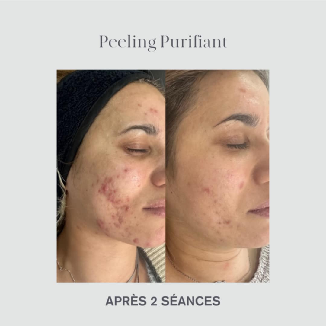 peeling-myriade-avant-apres