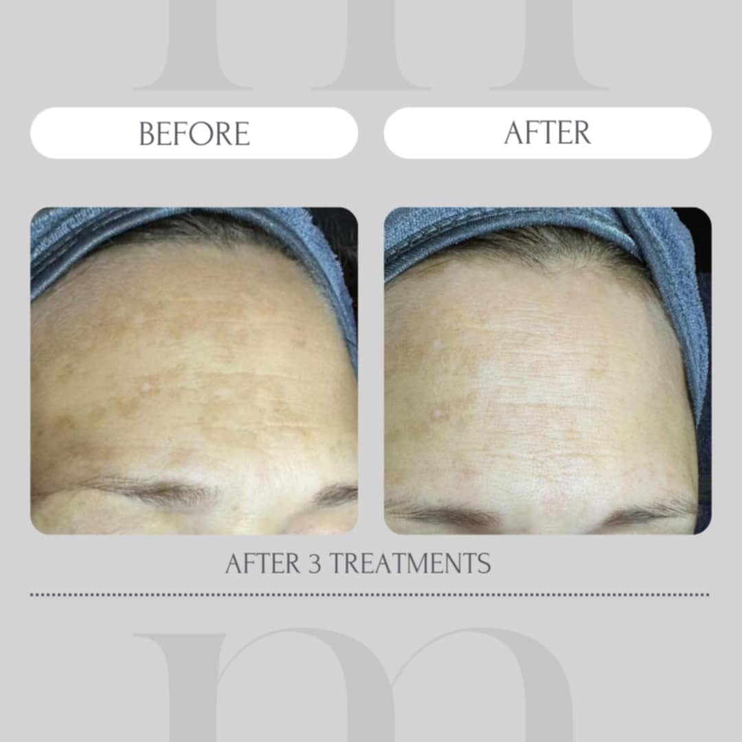peeling-myriade-avant-apres
