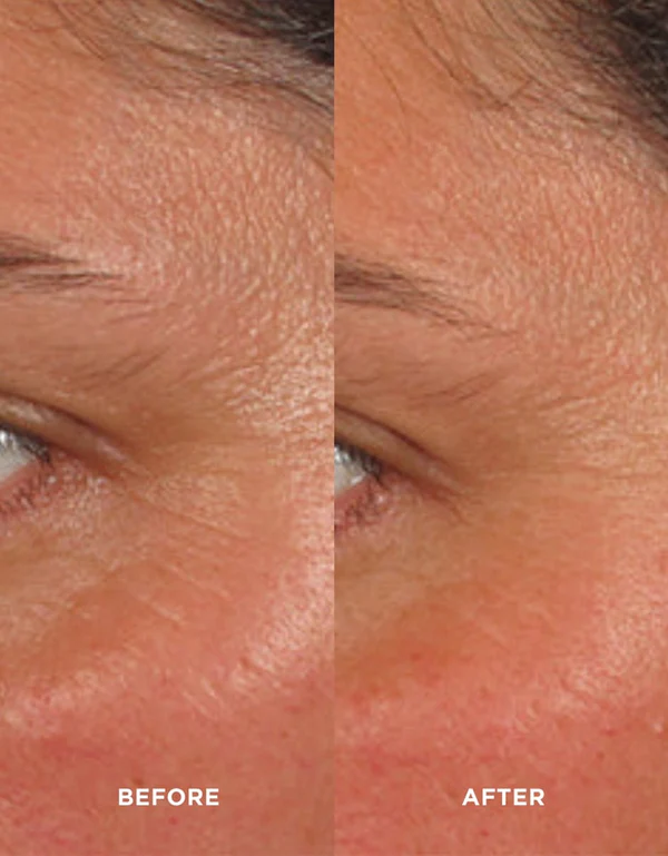 image-skin-care-avant-apres rides