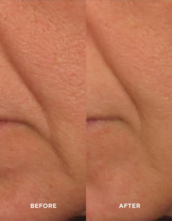 image-skin-care-avant-apres fermeté