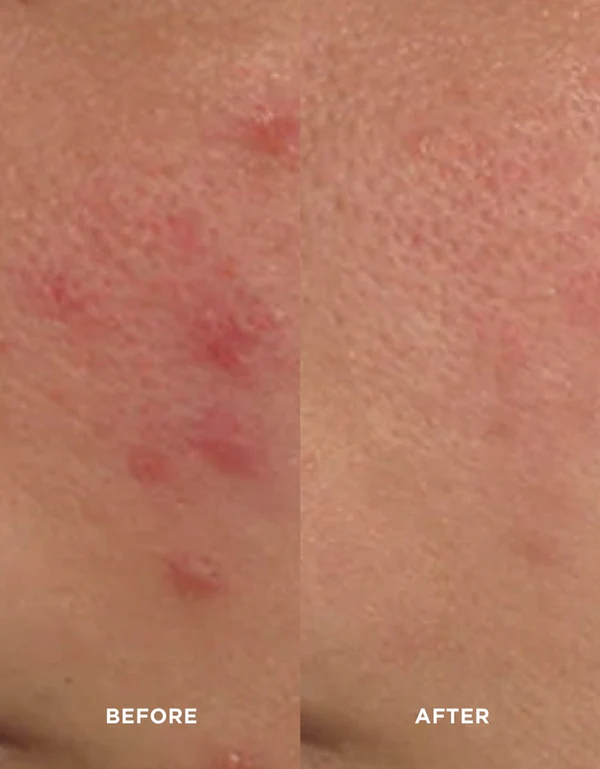image-skin-care-avant-apres acné