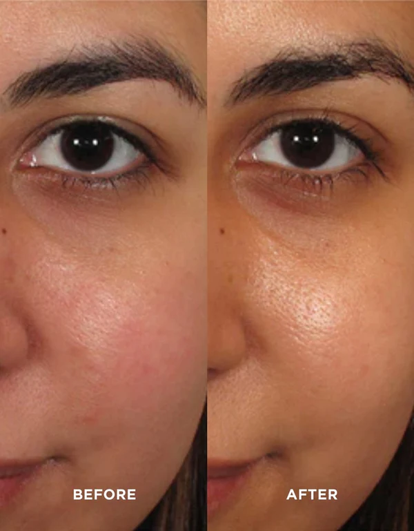 image-skin-care-avant-apres taches et teint